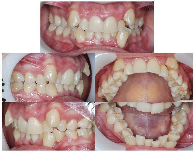 although there are inflammatory changes of the gums, especially in the areas with crowed teeth (fig. 2). Romanian Journal of Oral Rehabilitation Figure 3.