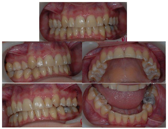 The evaluation of the lateral cephalometric radiograph at the end of treatment shows a reduction of the dental compensation and an improved position of the soft tissues.