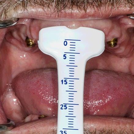 central incisor. B. B.1.