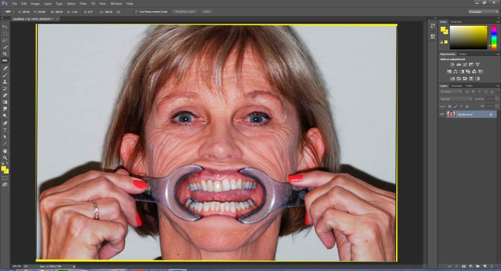 In order to level the image, the Digital Stick Bite photo is loaded into PhotoShop, activate the Measure Tool function on left toolbar, click icon onto the 1 pupil and drag a line right through the
