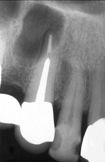 Inverted Y Locule in maxillary sinus: note tooth periodontal ligament space intact Septum in