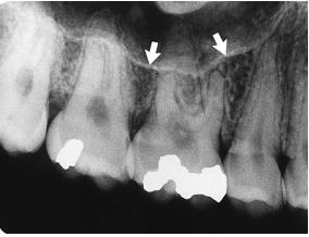 When the rounded sinus flor dips between the buccal and palatal molar roots and is medial to the premolar roots, the projection of the apices is superior to the flor.