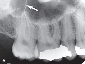 one or several radiopaque lines traverse the image of the Maxillary sinus.these opaque lines are called septa.