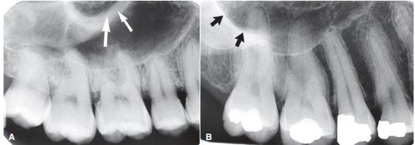 ZYGOMATIC PROCESS an extension of the lateral maxillary surface Apex of first & second molars a U-shaped radiopaque line with its open end directed superiorly.