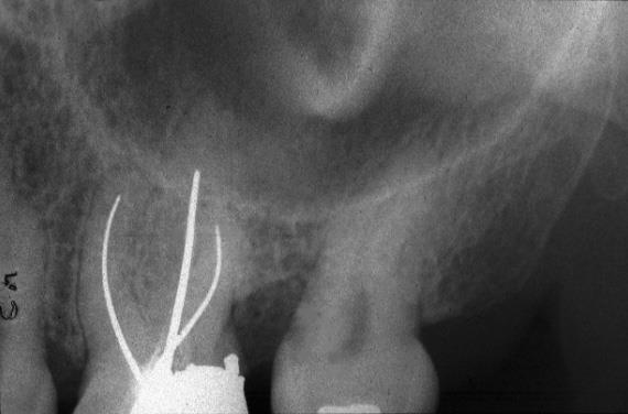 Endodontically treated tooth Zygomatic process of the maxilla