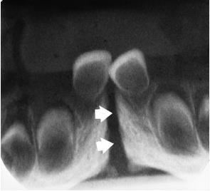 forming deciduous central incisor fuses