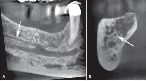 MANDIBULAR CANAL a dark linear shadow with thin radiopaque superior and inferior borders The width of the canal shows some interpatient variability but is usually constant anterior to the third molar