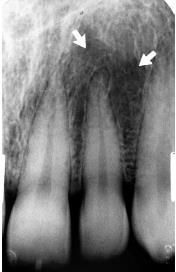 LATERAL FOSSA incisive fossa a gentle depression in the maxilla near the apex of the lateral