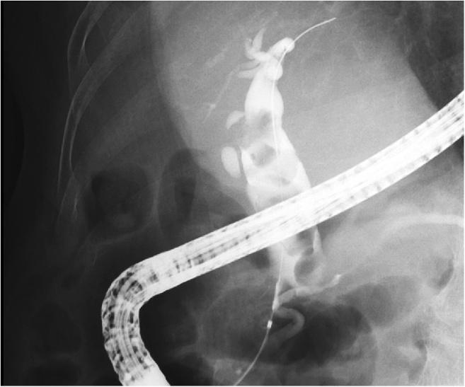 Tsuchida et al. BMC Gastroenterology (2015) 15:59 Page 2 of 6 Background Endoscopic sphincterotomy (EST) is widely recognized as a standard endoscopic treatment for common bile duct stones.