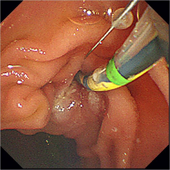 Tsuchida et al. BMC Gastroenterology (2015) 15:59 Fig. 2 EST before EPLBD. EST was performed before EPLBD in patients who did not receive papillary treatment before balloon dilation catheter.