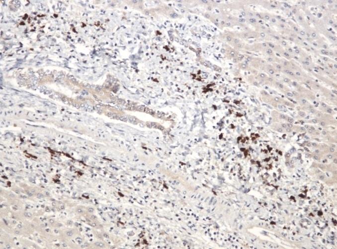 IgG4-associated Sclerosing Cholangitis Role of IgG4 Immunohistochemistry > 10 IgG4+ cells/hpf generally accepted as suggestive/diagnostic Problems: 1. Variable size of high power fields 2.
