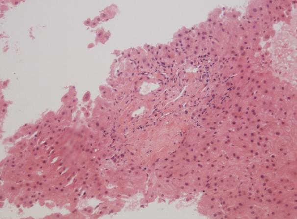 PSC/AIH Overlap Syndrome Role of Liver Biopsy in a Patient with a Diagnosis of AIH New onset AIH