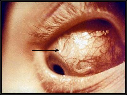 Clinical Manifestations / Pathology Eye