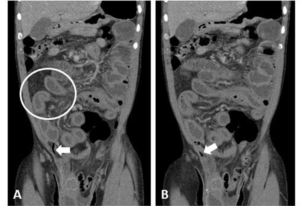 Figure 2: 47 year old male with right-sided Amyand's hernia.