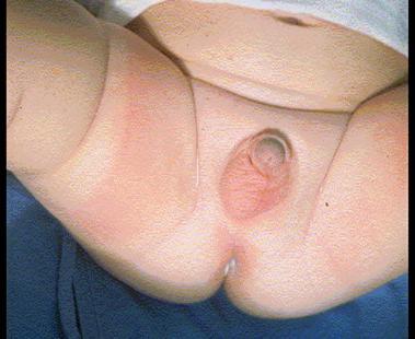 Scrotum impalpable testis Can it be manipulated into the scrotum?