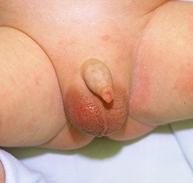 Scrotum: testicular torsion