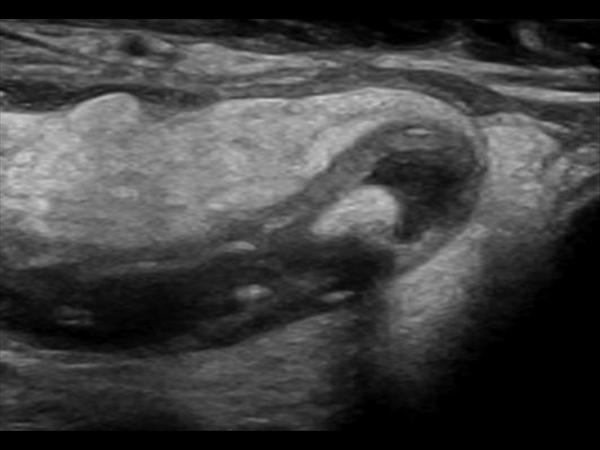 Ultrasound: blind-ending, non-compressible, thickened (>8mm)