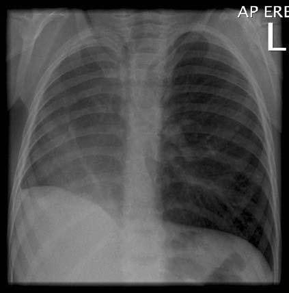 Diagnosis: Partial anomalous pulmonary venous return Partial anomalous pulmonary venous return (PAPVR) is a rare form of congenital heart disease in which one or more of the pulmonary veins drain