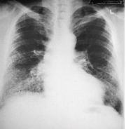 IPF/UIP: Radiographic Findings HRCT Pattern Consistent
