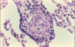 Endstage Fibrosis ( Honeycomb lung ) Major Histopathological