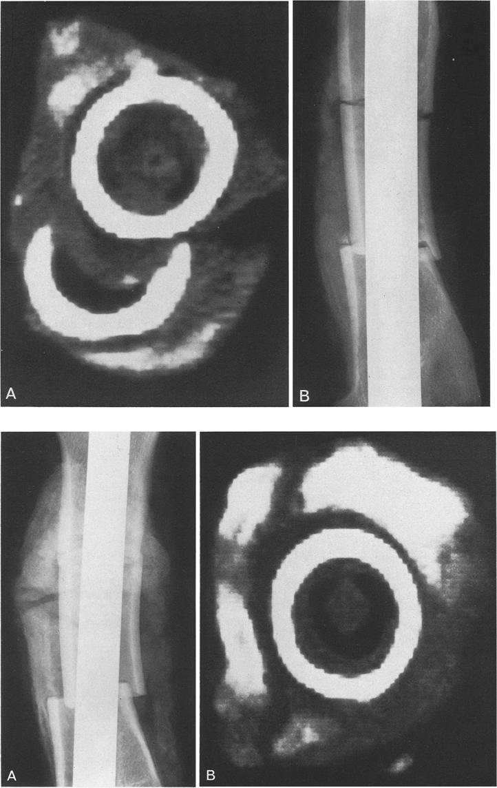 28 E.M. Braunstein et al. : CT and plain radiography in experimental fracture healing Fig. 1 A, B. Three weeks after osteotomy A On CT, the overlapping sharp edges at the osteotomy are well defined.