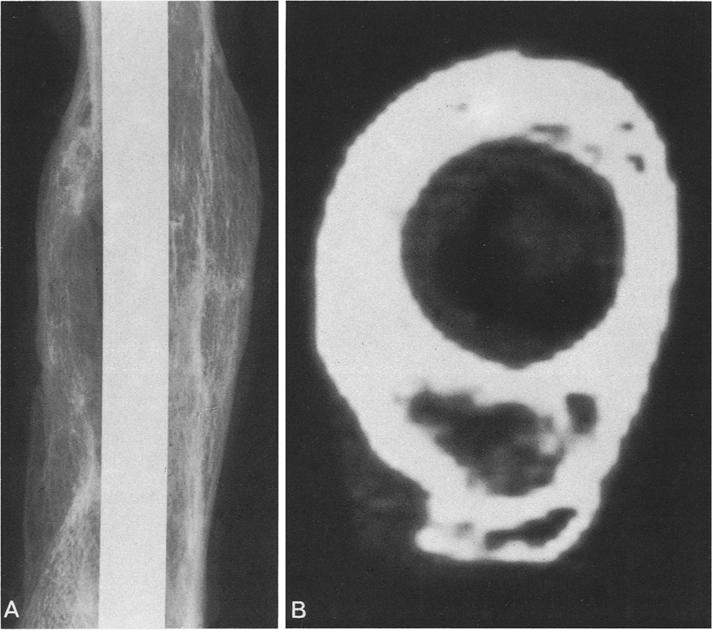 30 E.M. Braunstein et al. : CT and plain radiography in experimental fracture healing Fig. 5A, B.