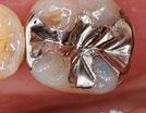 Finally, this tooth-colored, naturally opalescent nano ceramic material offers properties that are almost identical to those of natural teeth, ensuring your patients the most