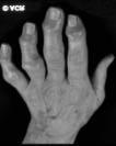 Case 2: Distal and Proximal Interphalangeal Joints Case 2: