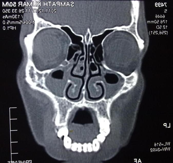 Figure 3: axial cut of the same patient showing deviated septum. Septum leading to OMC obstruction.