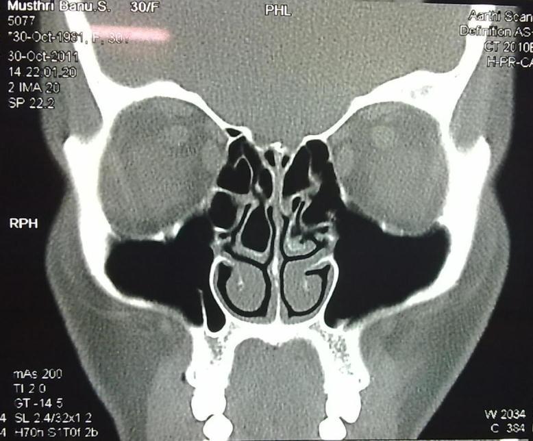 l Figure 5: CT image of another patient with extensive pneumatization of the right middle turbinate.