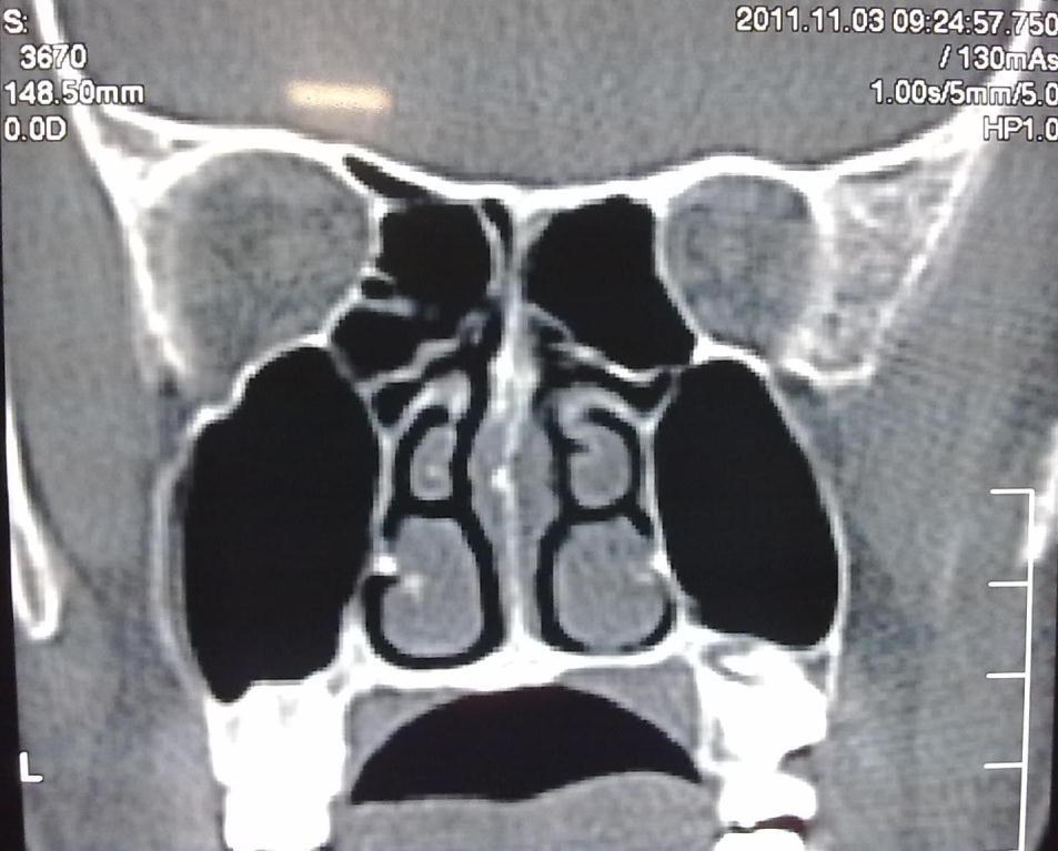 Figure 6: CT scan of a patient showing paradoxical middle turbinates Aim of study: Is to assess the role of anatomical obstruction in the pathogenesis of chronic sinusitis.
