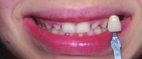 Clinical Case 1 This young patient first had a course of orthodontic treatment to align the rest of the teeth.