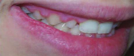 This figure shows the appearance on the teeth immediately after completion of orthodontic treatment and the removal of braces.