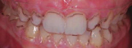 The retainers that were made were used as bleaching trays. The uneven gingival height discrepancy between the centrals and the lateral incisors was assessed.