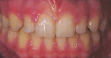 Case 2 This patient with peg-shaped laterals had orthodontic treatment undertaken by Dr Gerry Bellman.