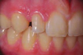 on the mesial side at end of treatment and less bonding would be necessary. Figure 6: View after removal of the orthodontic brackets.