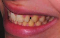 Figure 11: The Final view of the composite bondings to the peg shaped laterals to close diastemas and improve the shapes of these lateral teeth.