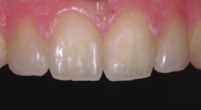 Figure 13: Isolation is essential when placing direct composite bonding to avoid saliva contaminating theenamel surface when bonding.