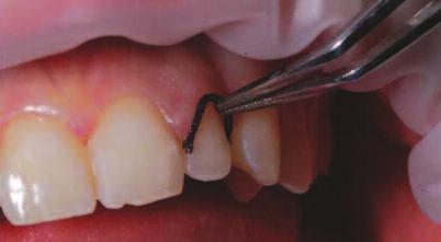 Here a black gingival retraction cord (Optident, IkleyYorkshire) was placed in order to assist with correct contouring and flow or the composite from the natural tooth