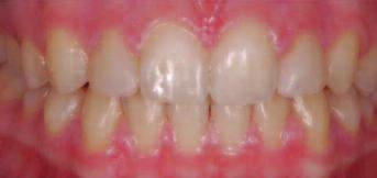 If both parents have peg laterals, the homozygous child will have total anodontia of succedaneous teeth (Witkop 1987).