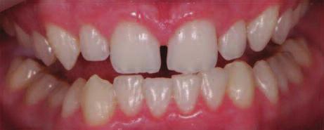 It is also evident that the right lateral incisor is shorter in crown length to height of gingiva than the left lateral incisor.