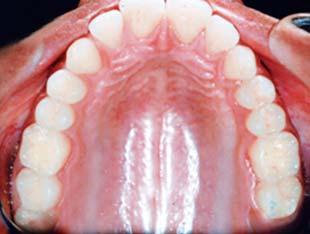 distalization of the mandibular left second premolar.