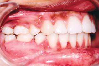 left buccal dental photograph, (H) post-treatment