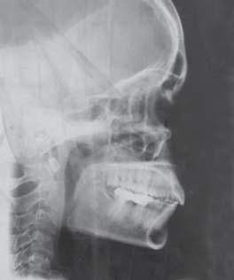 cases with missing molar are a challenge for the
