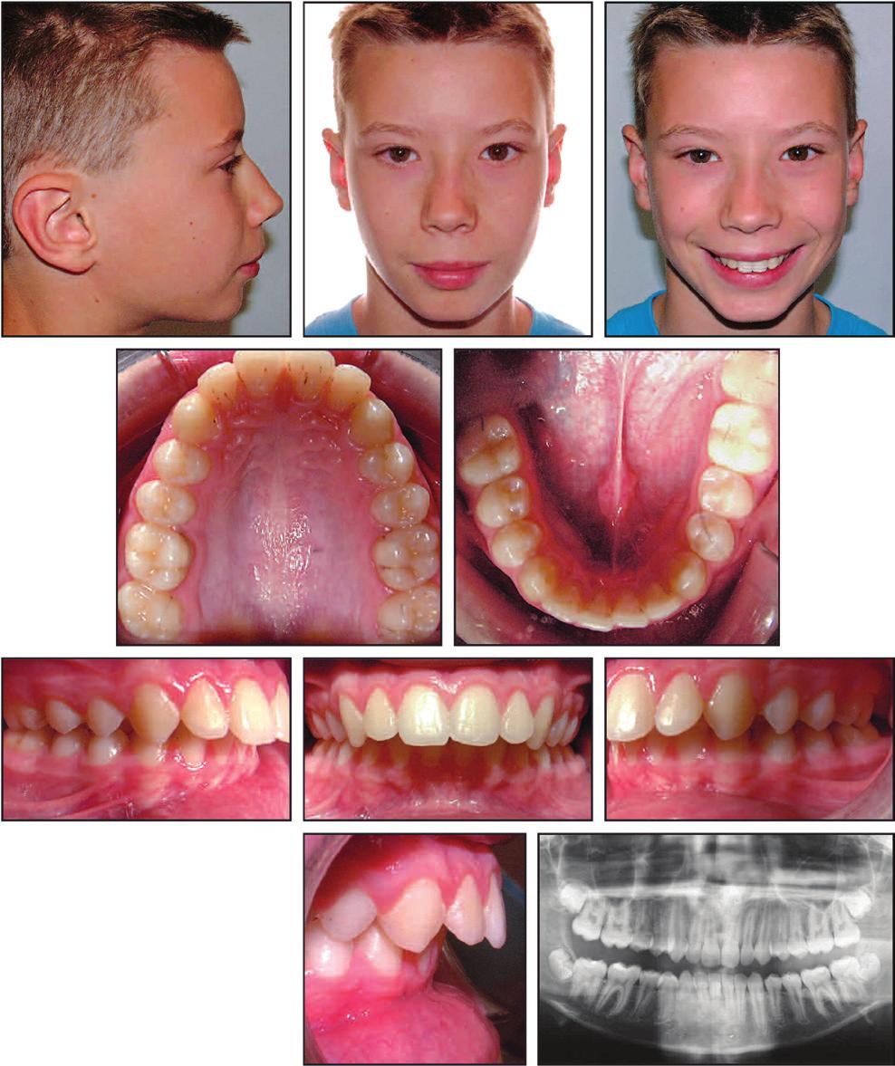 Boyd: Complex Orthodontic Treatment Using a New Invisalign Protocol 13-year-old male