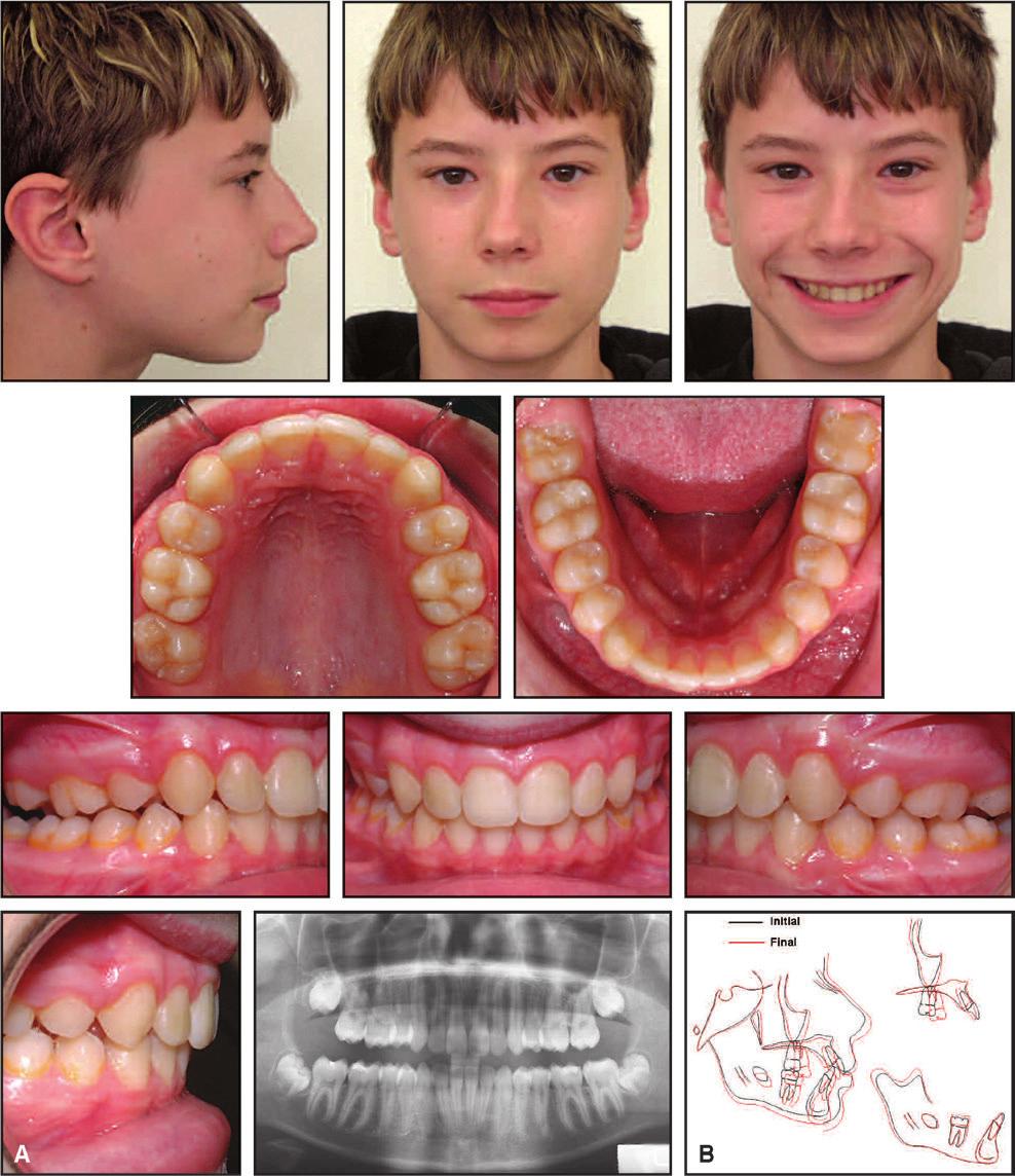 Boyd: Complex Orthodontic Treatment Using a New Invisalign Protocol A.