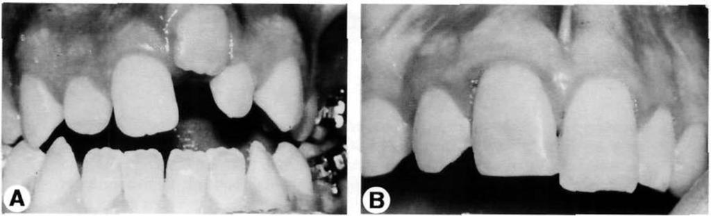 and mitigate the formation of an extensive alveolar ridge defect? A~fised teeth fi'equently ankylose after replantation.