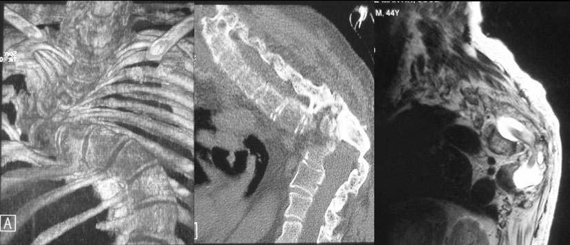 Paraplegia was due to vertebral rotatory subluxation in severe dystrophic kyphoscoliosis (Images A, B, C).