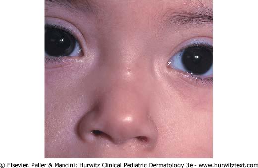 Dermoid sinus (or cyst) Epithelium lined tract (or cyst), may contain adnexal structures (hair follicles, sebaceous glands) Protruding tuft of hair pathognomonic Can be difficult to