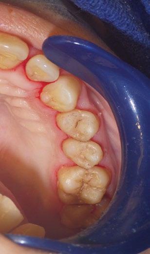tooth surface. With the proper amount of moisture, the tooth surface should appear with no pooled water before GIC placement.